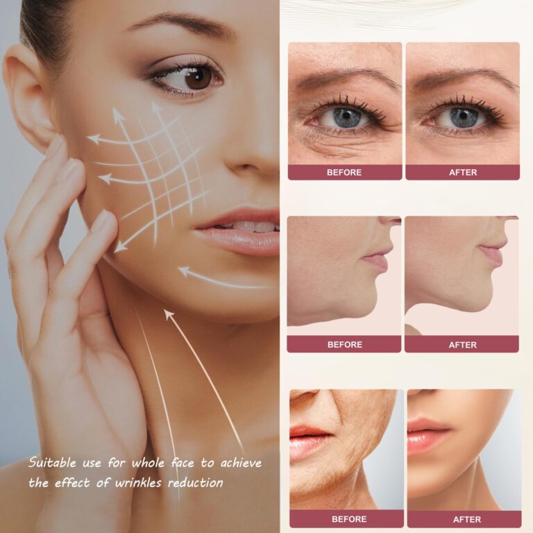 MZONG Non - Wireless RF Skin Rejuvenator - LED Light Combo for Face & Body Wrinkle Reduction - Image 7